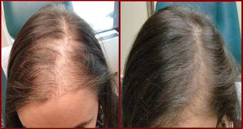 Female hair loss treatment can be a tricky topic for some. Vampire Hair Restoration - MISBIW ⎮ Medical Innovative ...