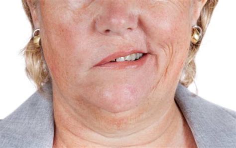Check spelling or type a new query. Bell's Palsy - Dr. Chopra's Physiotherapy & Pain Clinic