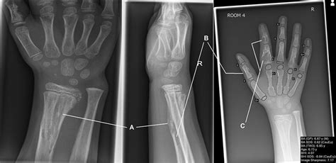 A Child With A Painless Deformed Wrist The Bmj