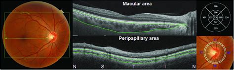 A Photographic Example Of Fundus Photography And Swept Source Optical