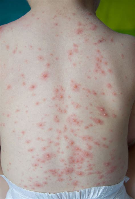 Chicken Pox Pictures In Adults