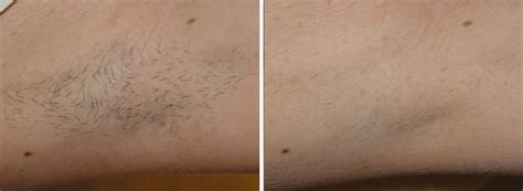 Indy laser guides you through what you should expect after laser hair removal treatments from indy laser skin care professionals. Laser Hair Removal | San Dimas, South Pasadena CA | The Beautx