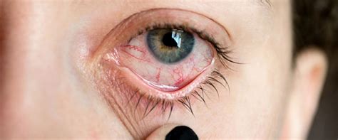 Read Insights About Red Bloodshot Eyes A Cause For Concern From