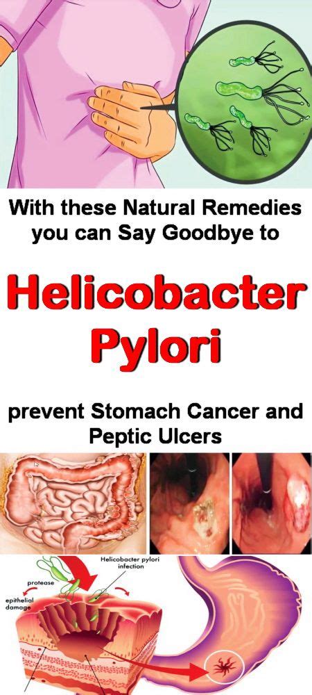 Natural Treatment For Helicobacter Pylori Healthymasters