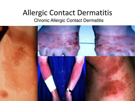 Ppt Contact Dermatitis Powerpoint Presentation Free Download Id634476