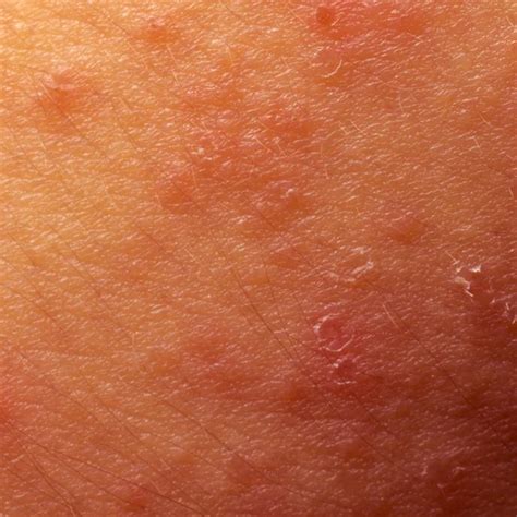 Eczema Groin Atopic Dermatitis Symptom Of Skin Texture Stockphotoscom