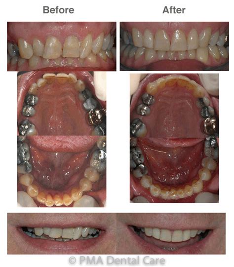 Adult Braces With Invisalign Pma Dental Care Dentist Gravesend Kent
