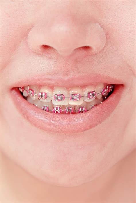 Swollen Gums With Braces