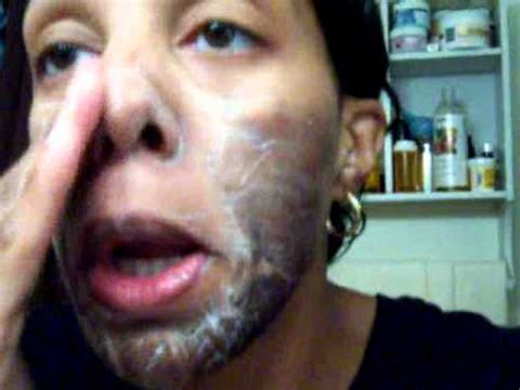 Check spelling or type a new query. Jessner's Chemical Peel 30% with 20% Salicylic Acid on top ...