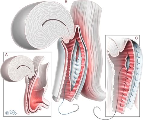 Above Midline Native Tissue Posterior Vaginal Repair Download Scientific Diagram