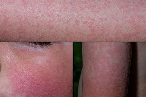 Fifth Disease In Children Causes Symptoms And Treatment