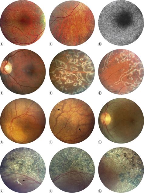 Heredodystrophic Disorders Affecting The Pigment Epithelium And Retina