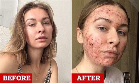 Woman 22 Shares Candid Selfies Of Severe Acne Which Suddenly Broke