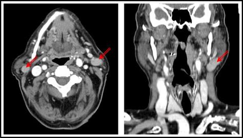 Contrast Enhanced Ct Scans Showed A Lesion Next To The Angle Of The