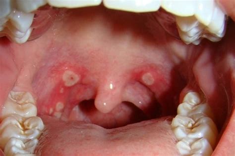 Throat Ulcers Causes Treatment Options Tua Sa De