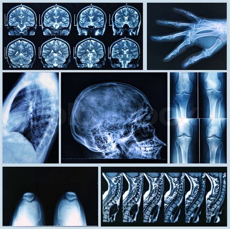 Radiography Of Human Bones Stock Image Colourbox