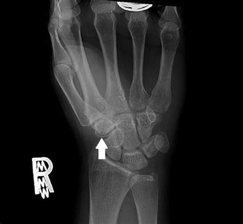 Approach To Isolated Trapezoid Fractures Ochsner Journal