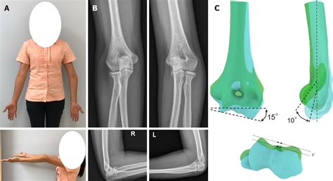 Three Dimensional Printing Technology For Patient Matched Instrument In