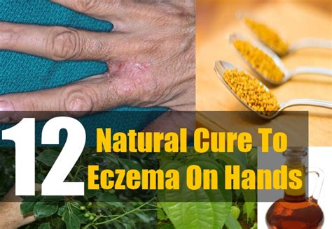 Irritants such as water or detergents) and atopic predisposition are often important triggers. 12 Natural Cure For Eczema On Hands - How To Cure Eczema ...