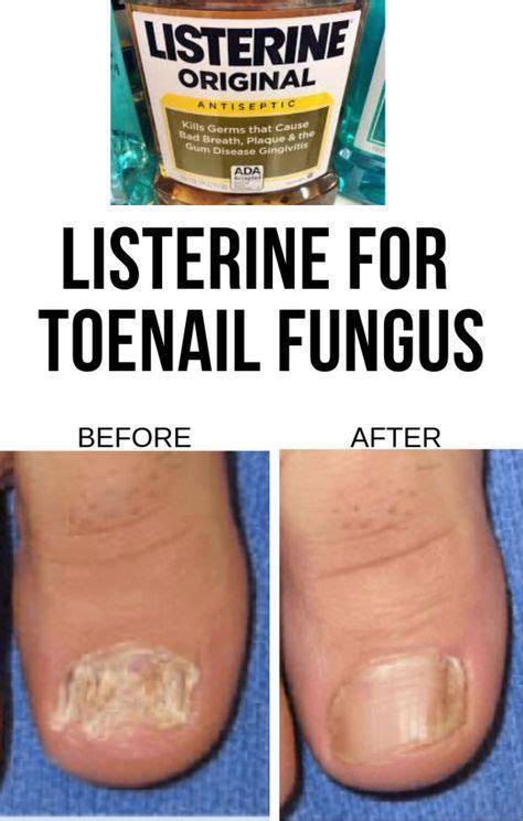 Best Listerine For Toenail Fungus In 2021 And Beyond Fungal Nail