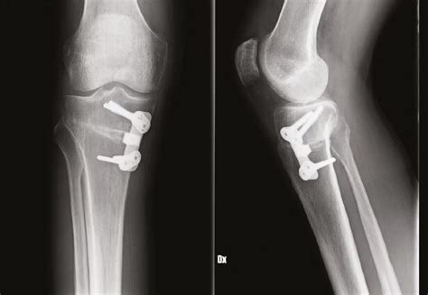 Corrective Proximal Tibial Osteotomy In A Varus Knee