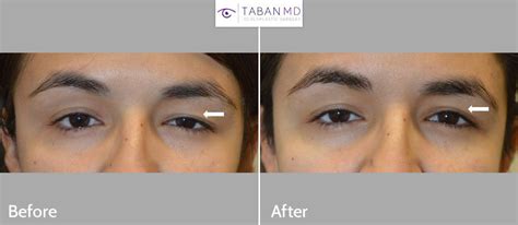 Eye Asymmetry Surgery And Treatment Fix Uneven Eyes