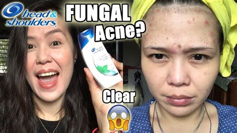 Get Rid Of Acne With Head And Shoulders 😱 Youtube