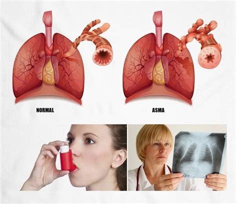 Trata El Asma La Bronquitis La Tos Y Enfermedades Pulmonares De Forma