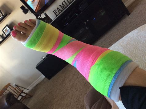 My Rainbow Sherbet Cast Leg Cast Broken Ankle It Cast
