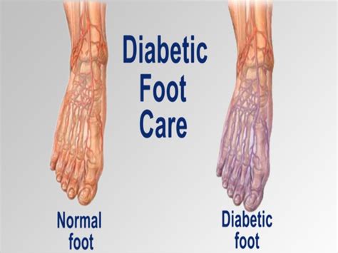 Improper Diabetic Feet Care Can Lead To Ulcers
