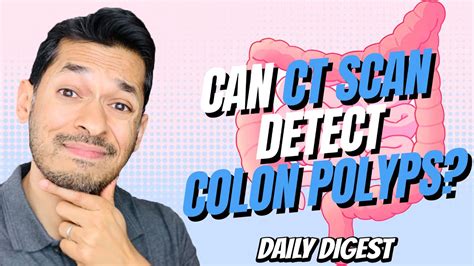 Can Ct Scan Detect Colon Polyps Youtube