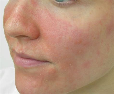 Facial Eczema Treatment Causes Symptoms Dermatitis Types Cream Relief
