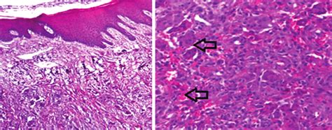 Photomicrograph Of Peripheral Giant Cell Granuloma Revealed