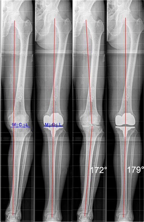 The Angle Between The Mechanical Axis Of The Femur And The Mechanical