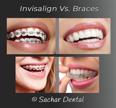 Dentist Nyc Invisalign Vs Metal Braces Sachar Dental Nyc
