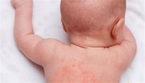 Alergia Alimentar em Bebê Cuidados Importantes Cantinho Infantil da