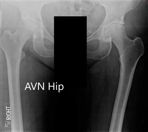 Case Study Left Hip With Avascular Necrosis In 65 Yr Old Male