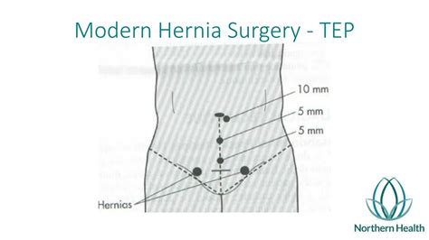 Ppt Management Of Inguinal Hernia Powerpoint Presentation Free