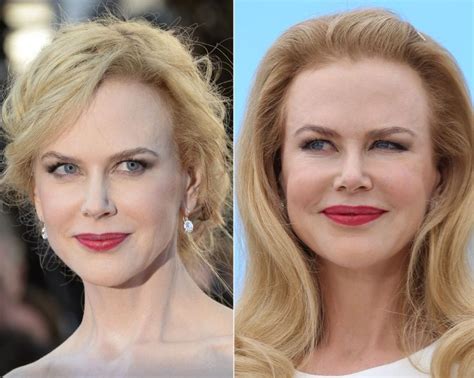 Nicole Kidman Before And After Plastic Surgery Celebrity Plastic Surgery Online