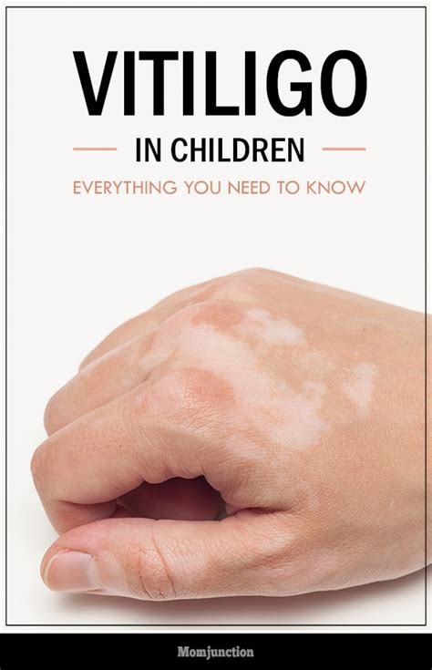Vitiligo In Children Prevention And Treatment