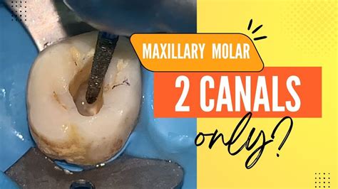 Maxillary Molar Access Opening Youtube