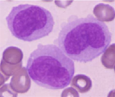 M5 Acute Monoblastic Leukemia Amol Download Scientific