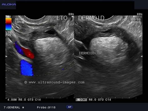 Ultrasound Image Gallery Dermoid Cyst Ultrasound Ovaries