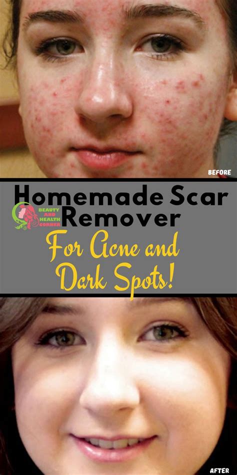 Homemade Scar Remover For Acne And Dark Spots Dark Spots On Skin