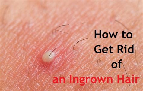 It there's any chance of this, talk to your doctor and get tested right. How to Get Rid of an Ingrown Hair