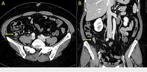Figure 4 From Perforated Appendicitis Presenting As A Soft Tissue