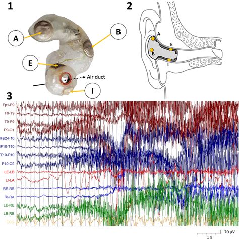 Figure 1 From Detection Of Generalized Tonic Clonic Seizures From Ear Eeg Based On Emg Analysis