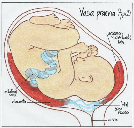 Information about placenta previa, a complication of pregnancy, which main symptom is vaginal bleeding. Illustration of a vasa praevia type 2. | Download ...