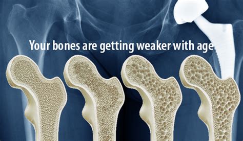 Special Offer Densitometry Check Your Bone Health Betterlifestyle