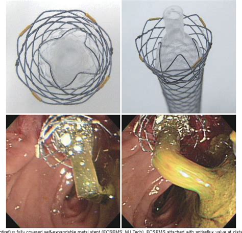 Figure From Functional Self Expandable Metal Stents In Biliary
